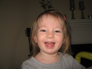 Magali hat Windpocken!